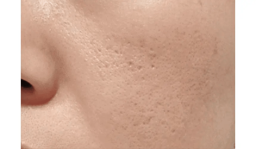 VUDE - Ultra-Low Molecular Diva Shot (Pore Care Beauty Device)