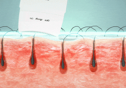 lilyeve Grow Turn Ampoule (Hair Loss Brush Ampoule)