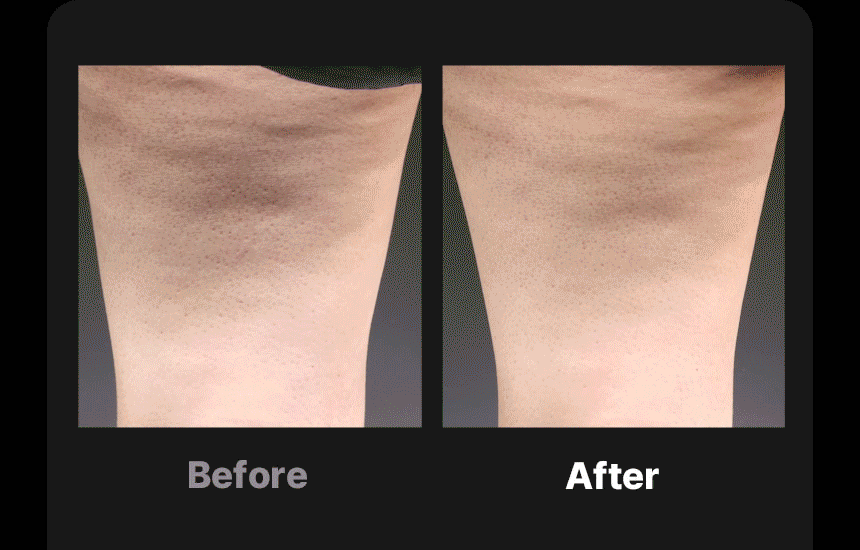 BEAUND - Leg Thin Beauty Device