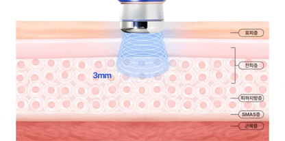 OLLIVIA - The Orlier S1 Beauty Device (Facial Contour &amp; Lifting Care)