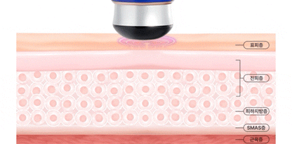 OLLIVIA - The Orlier S1 Beauty Device (Facial Contour &amp; Lifting Care)