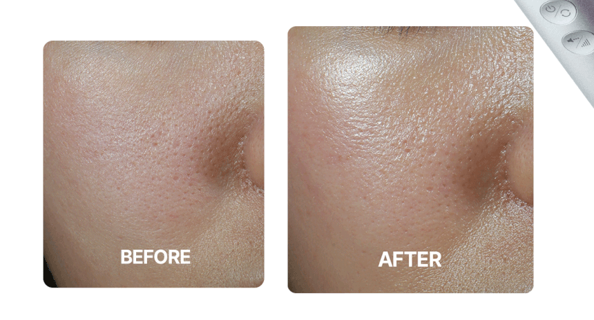 Centellian24 - Madeca Prime Max (Hyper Lifting &amp; Firming Beauty Device)