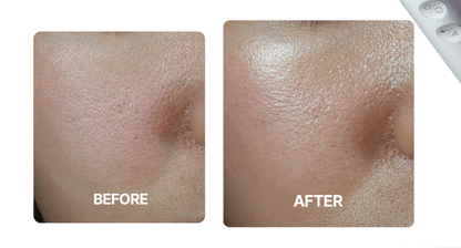 Centellian24 - Madeca Prime Max (Hyper Lifting &amp; Firming Beauty Device)
