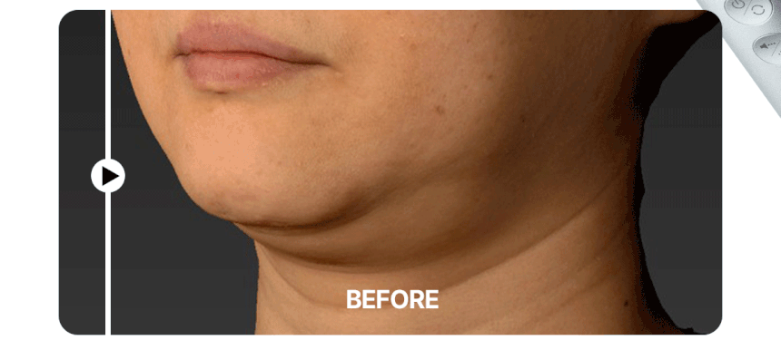 Centellian24 - Madeca Prime Max (Hyper Lifting &amp; Firming Beauty Device)