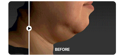 Centellian24 - Madeca Prime Max (Hyper Lifting &amp; Firming Beauty Device)